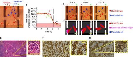 Metas-Chip precisely identifies presence of micrometastasis in live biopsy samples by label free approach