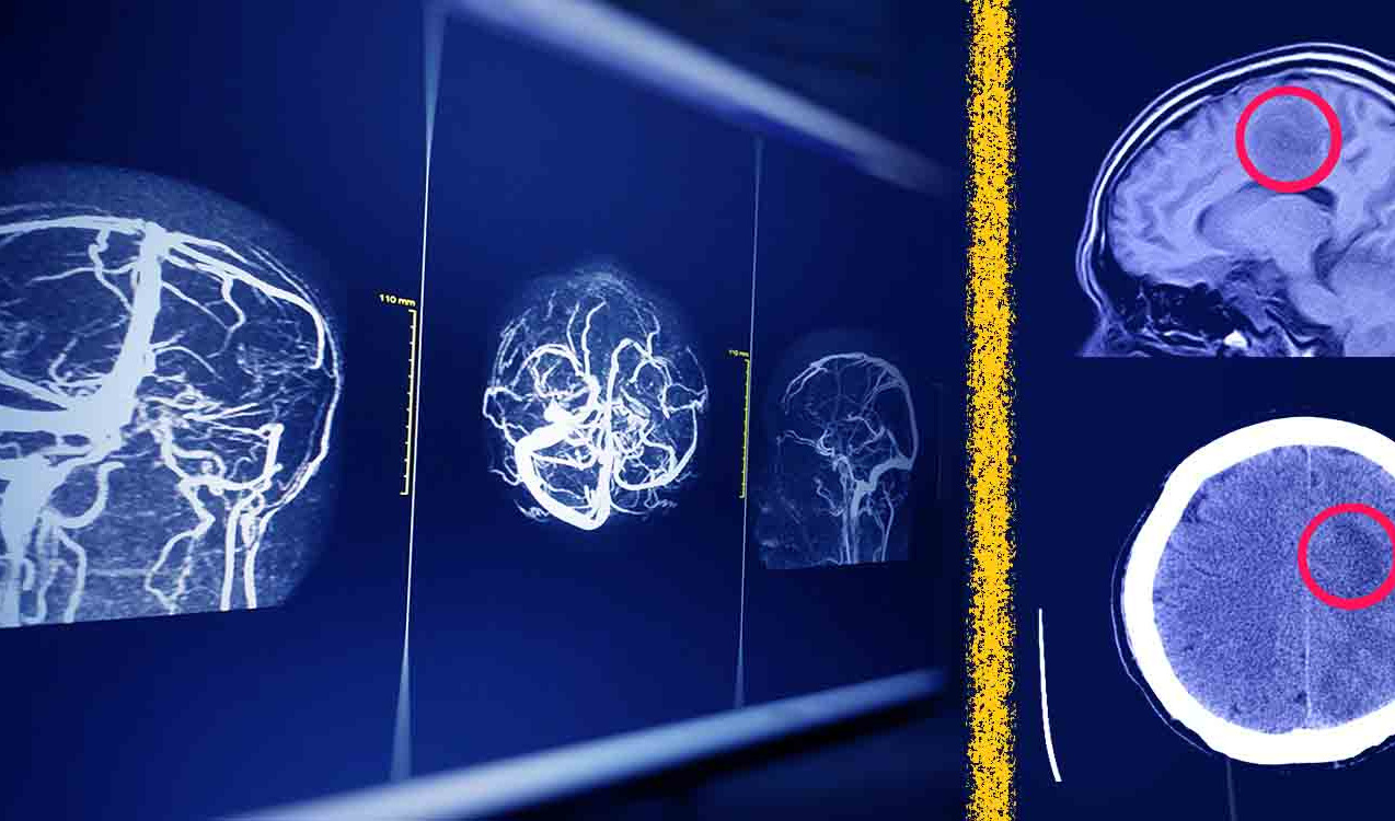 راه‌ حل جدید پژوهشگران دانشگاه تهران برای افزایش امنیت هوش مصنوعی در تحلیل MRI مغز