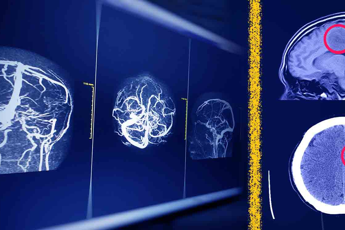 راه‌ حل جدید پژوهشگران دانشگاه تهران برای افزایش امنیت هوش مصنوعی در تحلیل MRI مغز